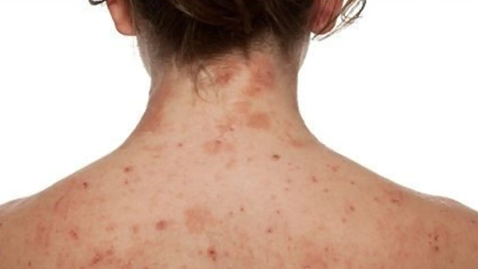 Atopic dermatitis: How the skin condition can play havoc with your mental health