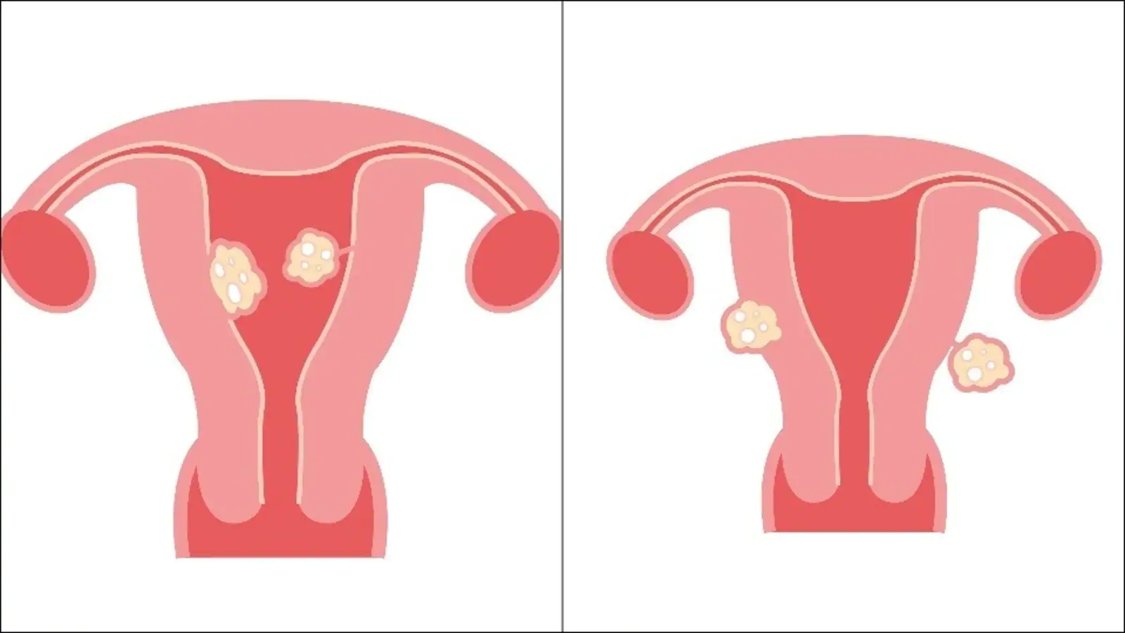 Fibroids: Types, causes, symptoms, risk factors, treatment of myomas by doctor