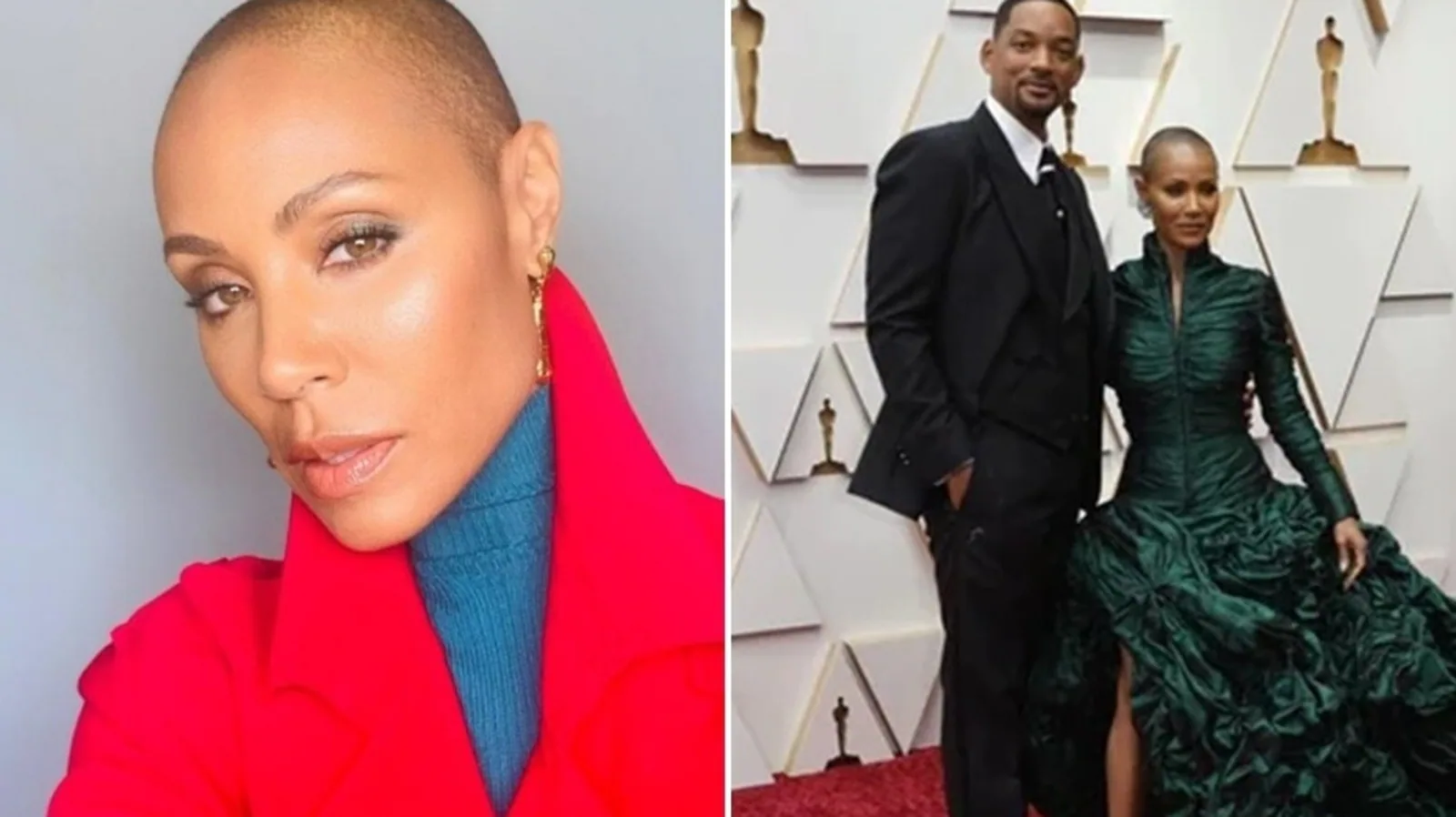 What is alopecia? All about the hair loss condition Jada Pinkett Smith suffers from