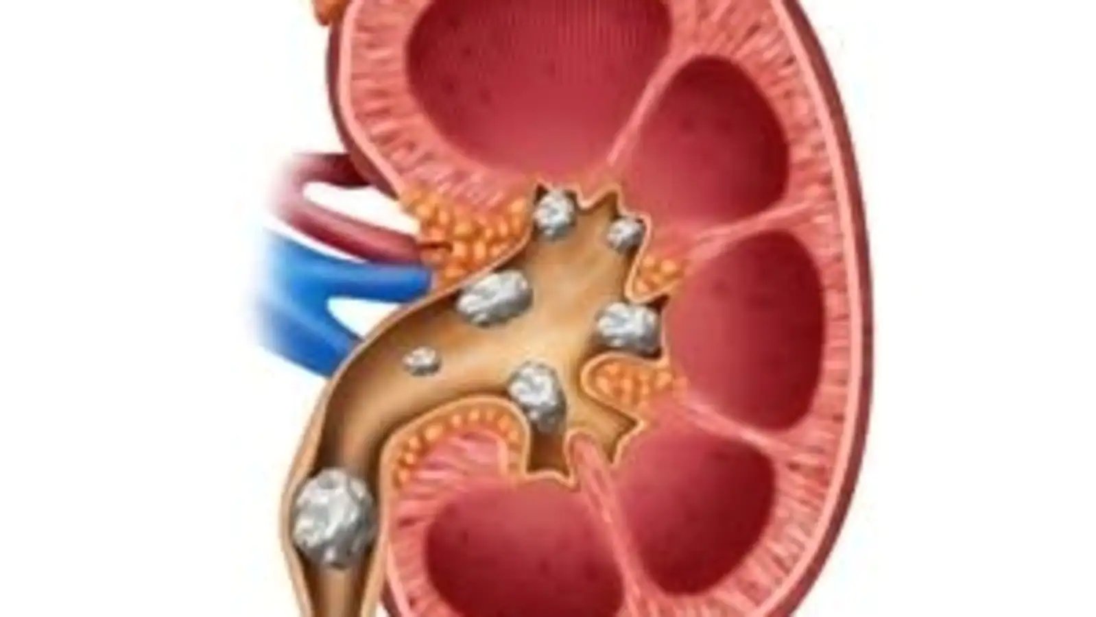 World Health Day 2022: Doctors share preventive measures to avoid kidney stones