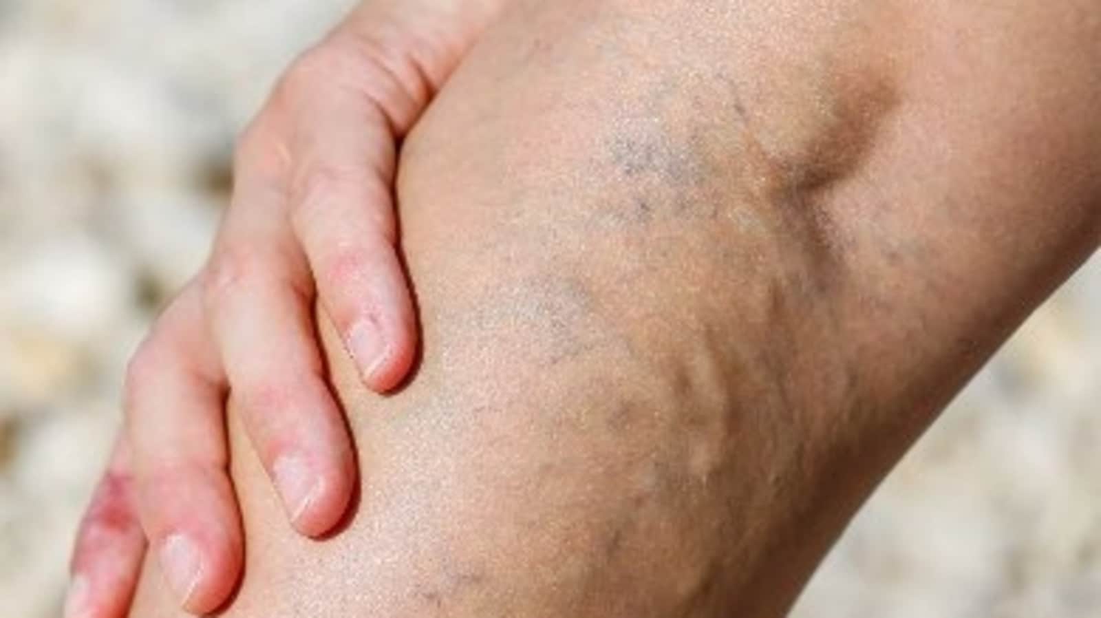 Varicose veins: Causes, symptoms, fitness tips to deal with it during summer