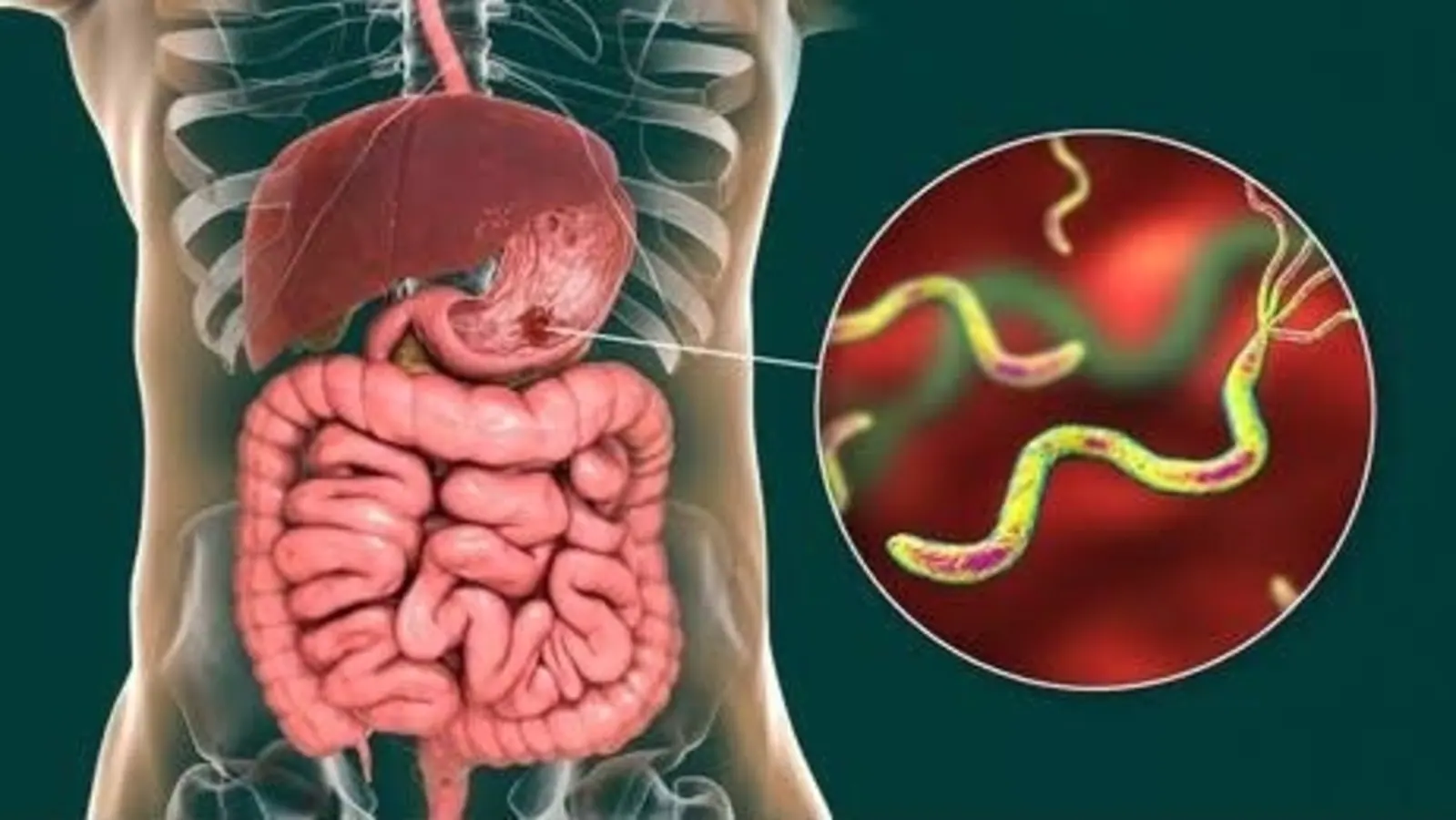 Ulcer: Doctors reveal causes, symptoms you should never ignore, treatment