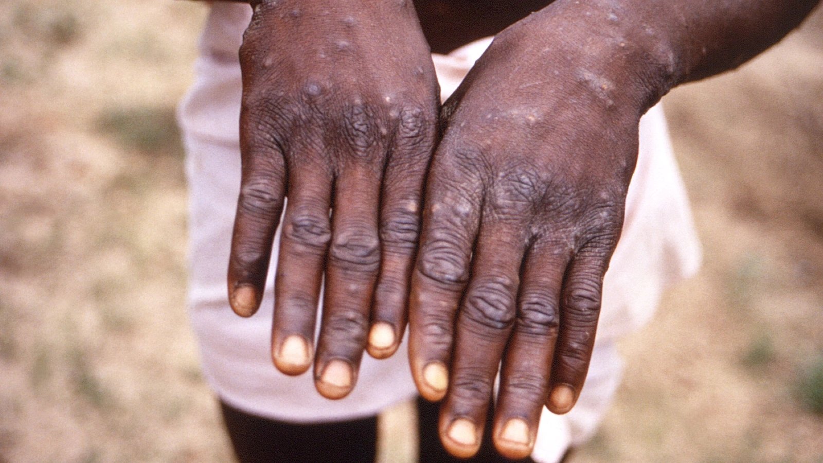 US reports 1st monkeypox case of 2022: 10 things to know