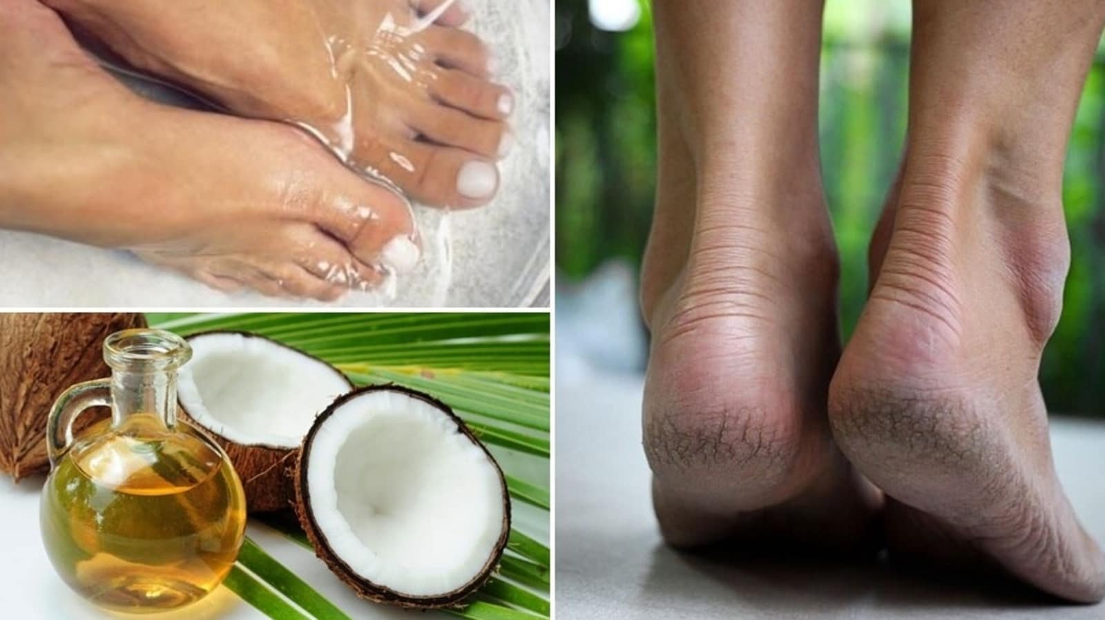 Worried about your cracked heels? Easy home remedies to treat them