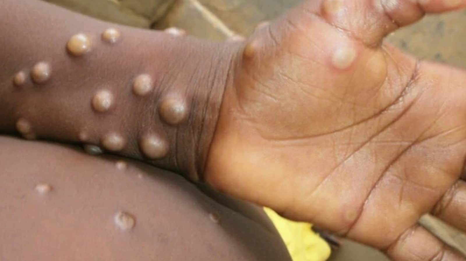 What is monkeypox and how it spreads; know symptoms from expert